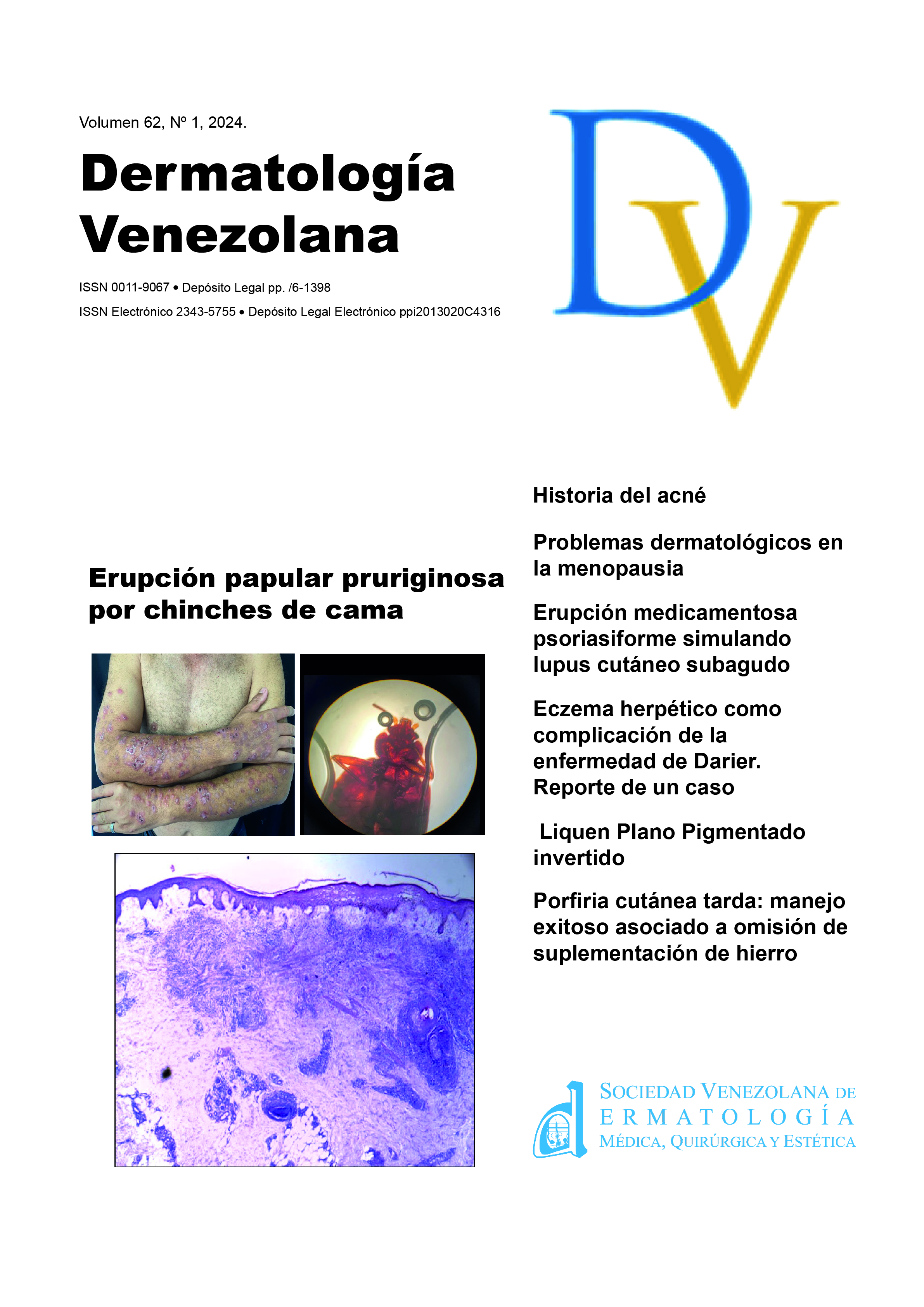 Ver Vol. 62 Núm. 1 (2024): Dermatología Venezolana